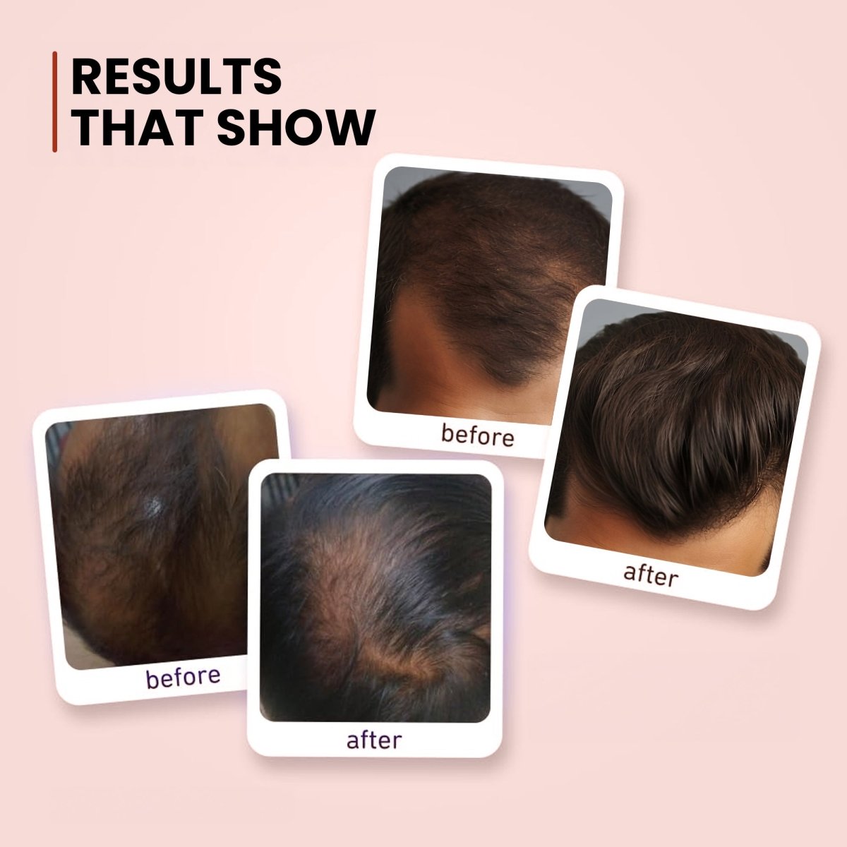 Male Hair Regrowth Therapy Combo Kit - DGCOSMETICO